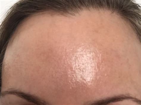 Tiny Bumps That Dont Go Away It May Be Pf Oily Skin