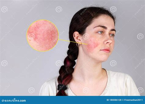 The Concept Of Rosacea A Young Caucasian Woman Shows Off A Red Cheek