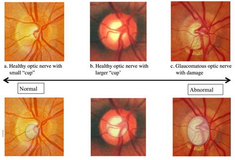 The head, neck and torso of the human body are connected to the brain via the brainstem through a network of 12 cranial nerves. Glaucoma Washington DC Maryland North Virginia