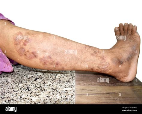 Fungal Infection Called Tinea Corporis In Leg Of Asian Woman