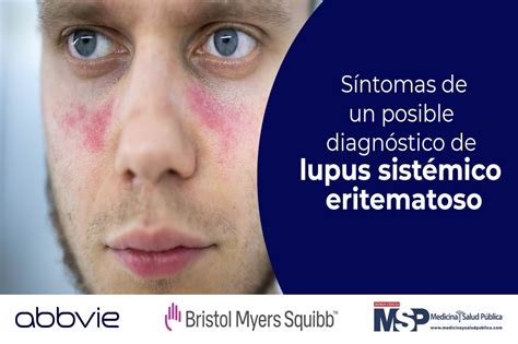 Síntomas De Un Posible Diagnóstico De Lupus Sistémico Eritematoso