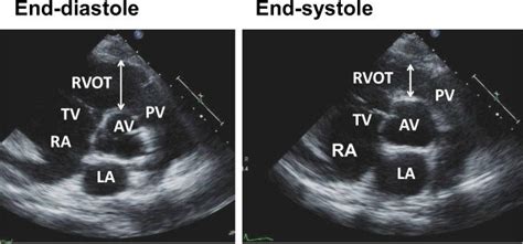 Two Dimensional View Of Right Ventricular Outflow Tract At End Diastole