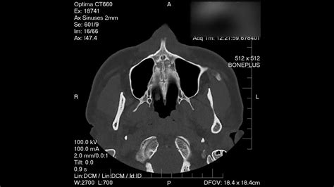 Deviated Septum Nasal Cat Scan Youtube