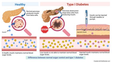 Diabetes Mellitus You And Your Hormones From The Society For Endocrinology