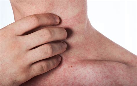 Rash On Neck Meaning Causes Itchy Red Bumpy Rash Diagnosis And