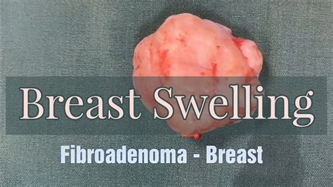 Breast Swelling Fibroadenoma Youtube