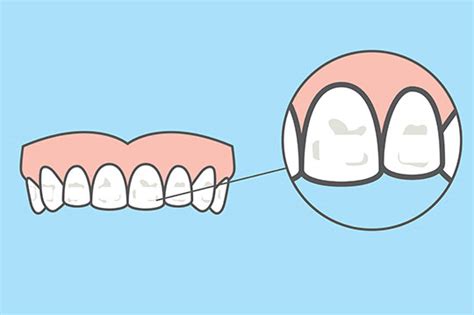 What Are White Spots On Teeth And What Can You Do About Them Advance