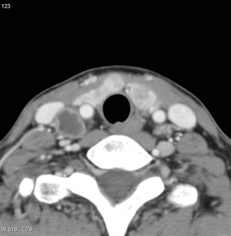 Papillary Thyroid Cancer Ct Wikidoc