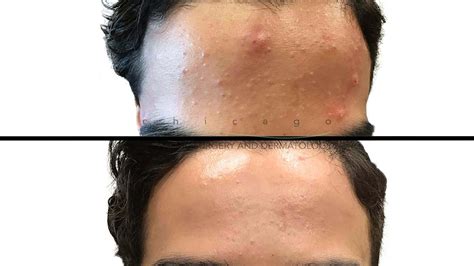Acne Chicago Cosmetic Surgery And Dermatology