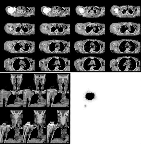 Lymphoscintigraphy For Sentinel Node Mapping Using A Hybrid Spectct