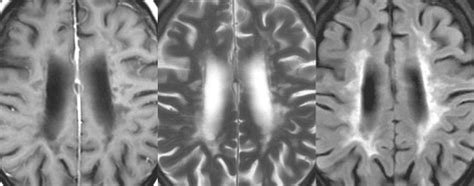 Imaging Basics Contrast To Noise Ratio Cnr Radiology Key