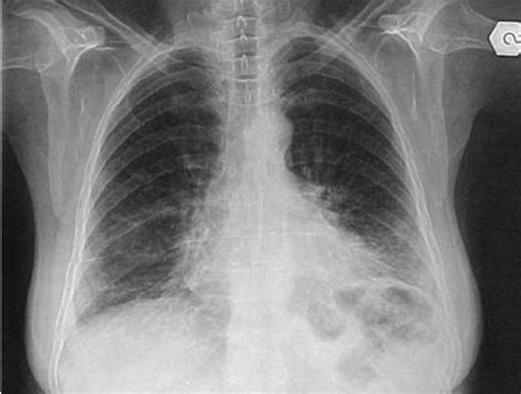 Chest Radiograph Of A Patient With Desquamative Interstitial Pneumonia
