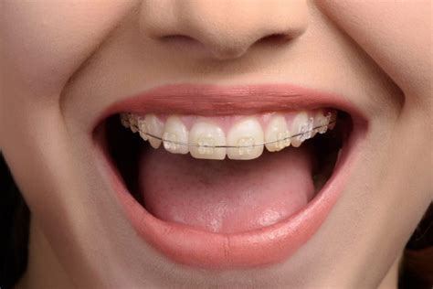 What Are Braces Ghosh Orthodontics