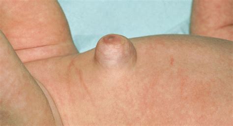 See more ideas about hernia inguinal, anatomy, anatomy images. Hernias in babies - BabyCenter Canada