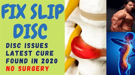 Slipped discs can occur in the cervical (neck) region, the thoracic. Slip Disc-Top 10 Easy Treatments Without Surgery [How to ...
