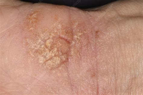 Eczema Stock Image C0498213 Science Photo Library