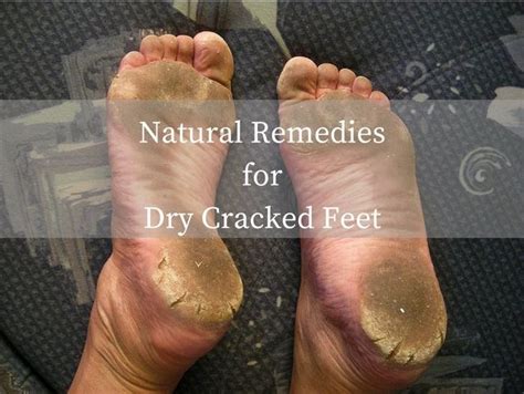 Natural Remedies For Dry Cracked Feet Pedicure Crackedheels Dry