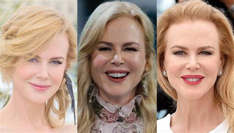 Nicole Kidman Plastic Surgery Before And After Pictures 2018