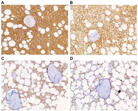 Immunohistochemistry Of The Hairy Cell Leukemia Cells In The Bone