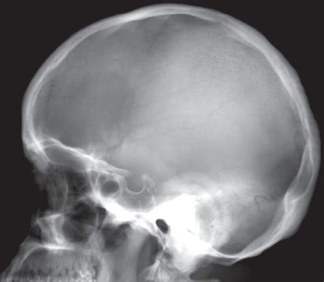 Lateral Radiograph Of The Skull Shows Hyperostosis Of T Open I