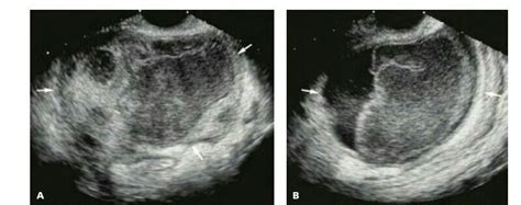 Tubo Ovarian Abscess A Transvaginal Image Of Complex Adnexal Mass