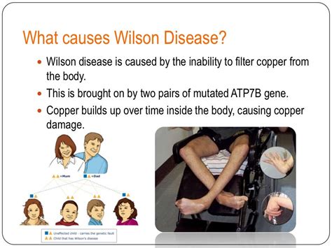 Wilson Disease Table 5