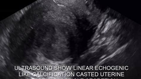 Case 179 Calcified Like Cast Uterine Infection Youtube