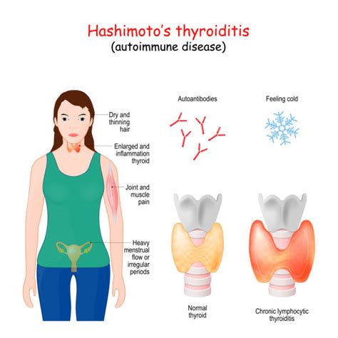 1200 Thyroiditis Stock Photos Pictures And Royalty Free Images Istock