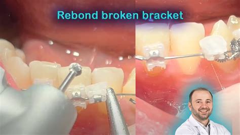 Bracket Came Out How To Refix Same Broken Bracket Rebond Falling Out Orthodontic Braces In 5