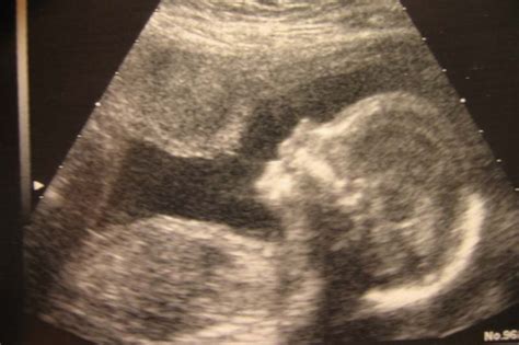 Feto De 26 Semanas Peso Y Talla - Club Madres | SEMANA 26: Ya está en posición fetal