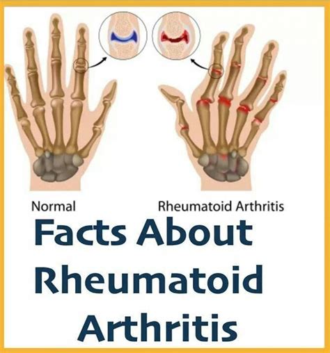 Rheumatoid Arthritis Facts Naturalarthritisrelief