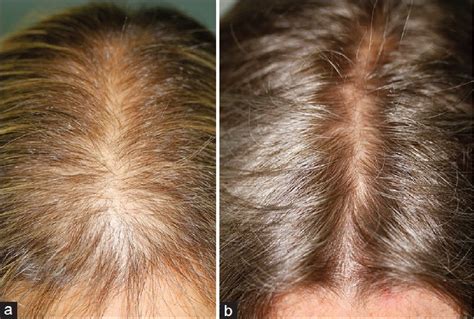 Pdf Finasteride 5 Mgday Treatment Of Patterned Hair Loss In Normo