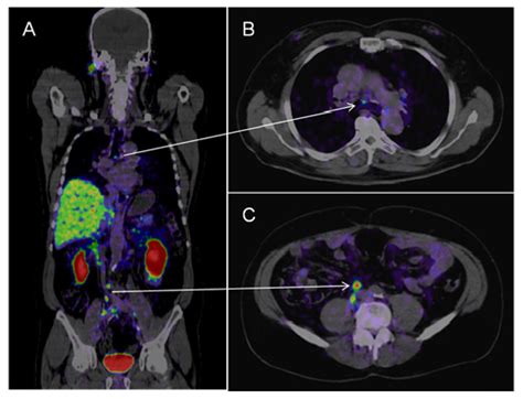 Ijms Free Full Text Molecular And Functional Imaging For Detection Of Lymph Node Metastases