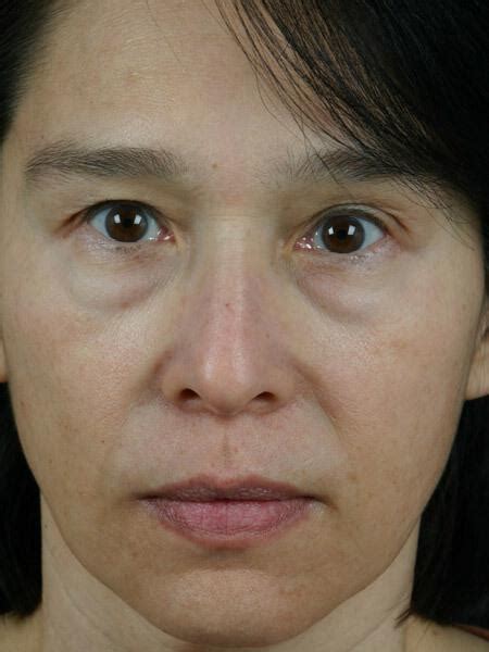 Before And After Wrinkle Reduction Procedures In Marina Del Rey Ca