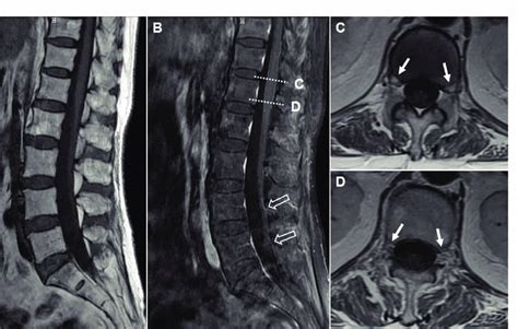 Cauda Equina Syndrome With Normal Mri Imaging Images Poster