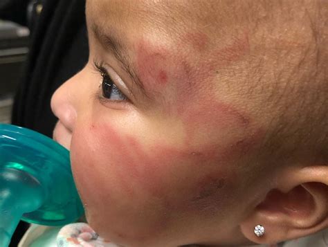 Mom Heartbroken As Six Month Old Baby Daughter Covered In Bruises And