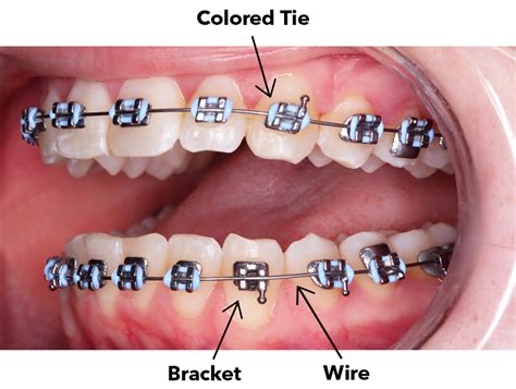 Braces And Invisalign How They Work Yang Orthodontics