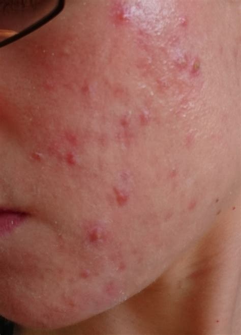 Roaccutane On The Nhs A Uk Blog Page 2 Accutane Isotretinoin