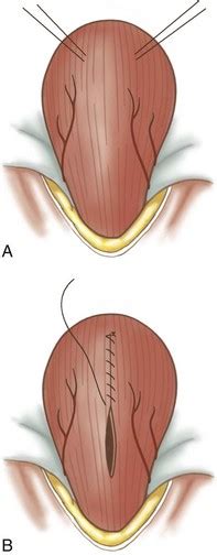 Surgery of the Bladder and Urethra | Veterian Key
