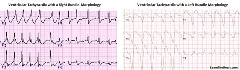 Ventricular Tachycardia Vt Ecg Review Criteria And Examples