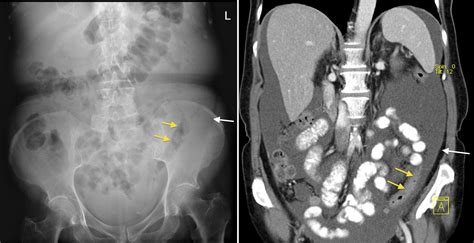 Ascites X Ray And Ct Radiology At St Vincents University Hospital
