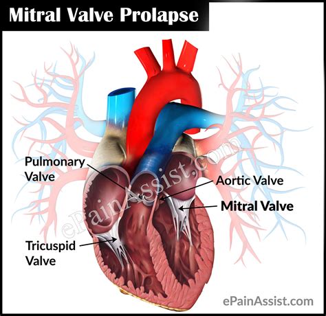 Mitral Valve Prolapse Or Floppy Mitral Valve Syndrome