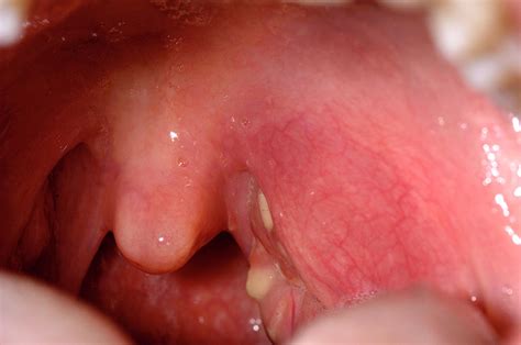 Inflamed Tonsil Photograph By Dr P Marazzi Science Photo Library
