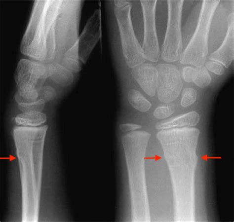Figure Buckle Fracture Of Distal Radius Contributed By Ajay Asokan