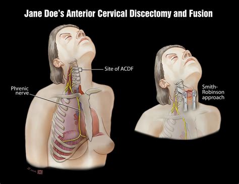 Anterior Cervical Discectomy And Fusion Level Five Graphics