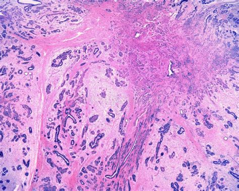 Human Breast Sclerosing Adenosis Stock Photo Image Of Epithelium