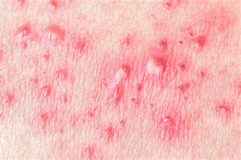 Hives Treatment And Remedies Us Dermatology Partners