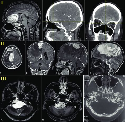 I A Brain Mri Sinonasal Neoplasm Sagittal Contrast Enhancing Acf