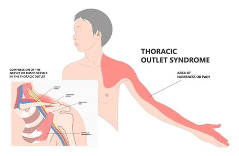 Thoracic Outlet Syndrome My Physio My Health