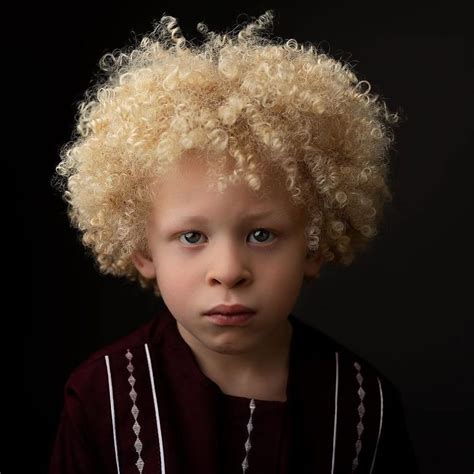 Albino With Black Hair Albinism In Humans Wikipedia